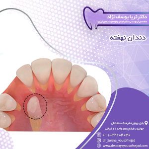 دندان نهفته - دکتر یوسف نژاد