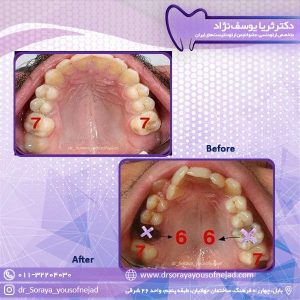 کشیدن دندان در ارتودنسی - دکتر یوسف نژاد