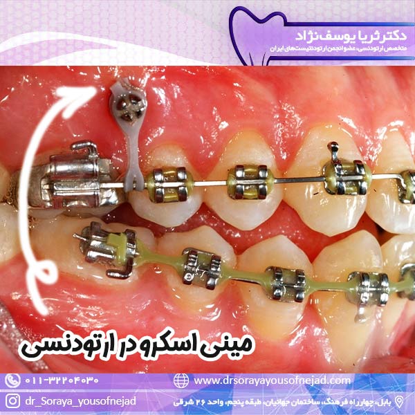 مینی اسکرو در ارتودنسی - دکتر ثریا یوسف نژاد drsorayayousofnejad.com