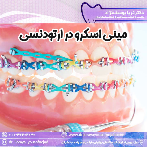 مینی اسکرو در ارتودنسی - دکتر ثریا یوسف نژاد drsorayayousofnejad.com
