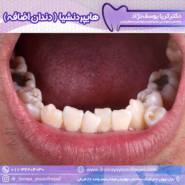 هایپردنشیا - دکتر ثریا یوسف نژاد drsorayayousofnejad.com