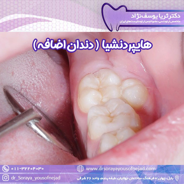 هایپردنشیا - دکتر ثریا یوسف نژاد drsorayayousofnejad.com