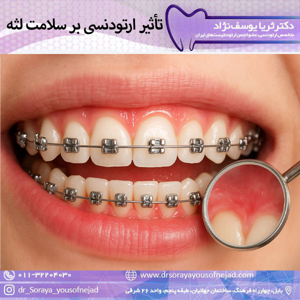 تأثیر ارتودنسی بر سلامت لثه