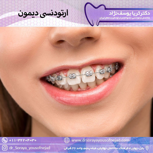 ارتودنسی دیمون