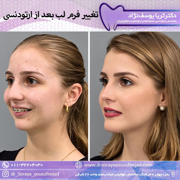 تغییر فرم لب بعد از ارتودنسی