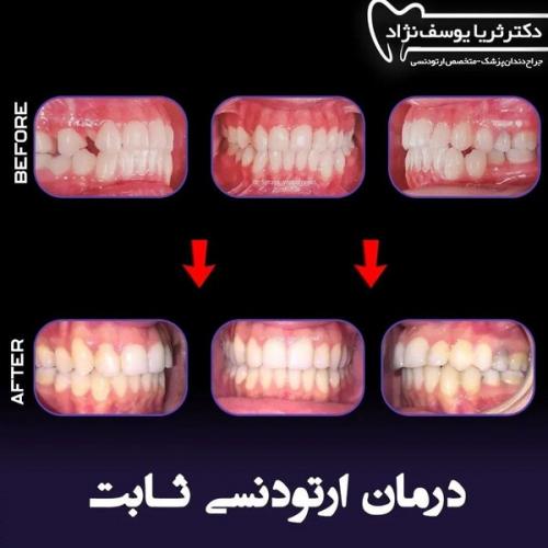 ارتودنسی-فک-بالا-و-پایین-178