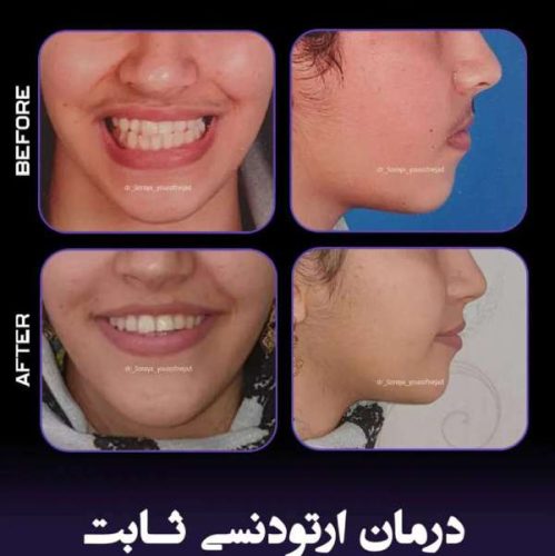 ارتودنسی-فک-بالا-و-پایین-237