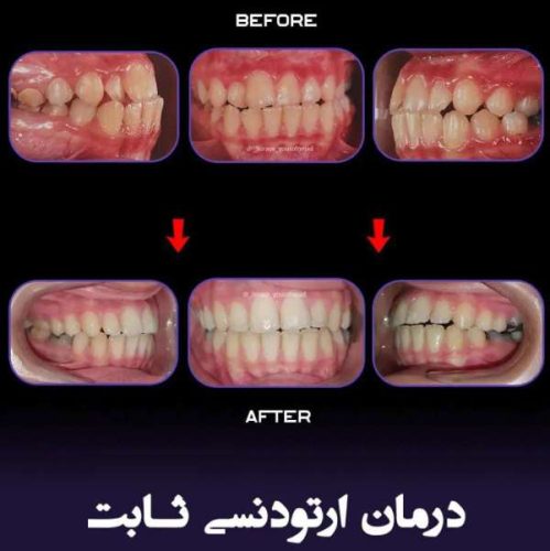 ارتودنسی-فک-بالا-و-پایین-238