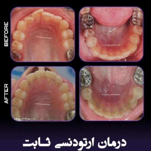 ارتودنسی-فک-بالا-و-پایین-239