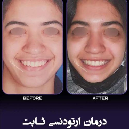 ارتودنسی-فک-بالا-و-پایین-240