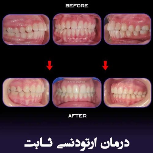 ارتودنسی-فک-بالا-و-پایین-241