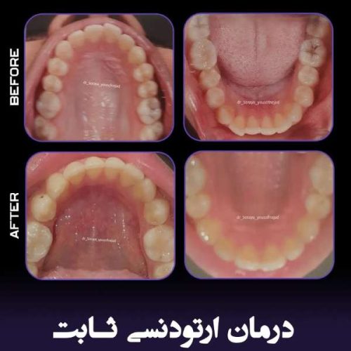 ارتودنسی-فک-بالا-و-پایین-242