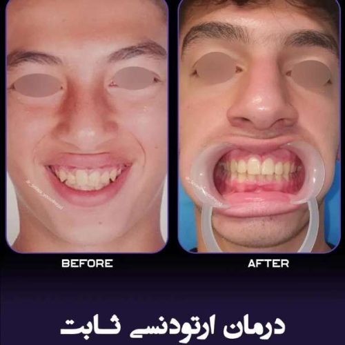 ارتودنسی-فک-بالا-و-پایین-243