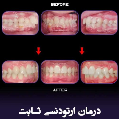 ارتودنسی-فک-بالا-و-پایین-244
