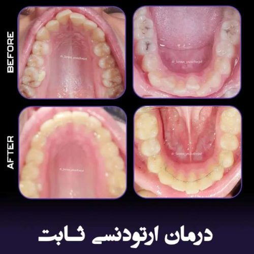 ارتودنسی-فک-بالا-و-پایین-245