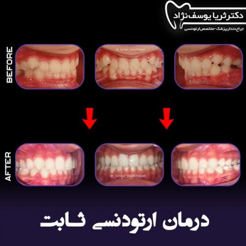 ارتودنسی-فک-بالا-و-پایین-158